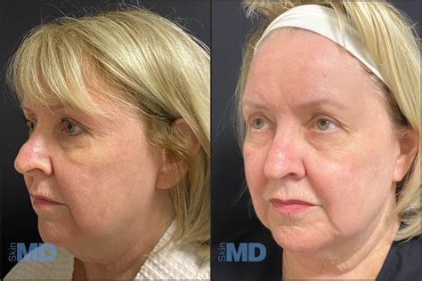 Morpheus8 Before and After Photos & Results | Face, Neck & More
