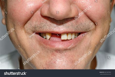 man smile   front teeth stock photo  shutterstock