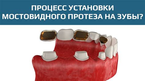 Мостовидные протезы: зубной мост для замещения нескольких зубов - YouTube