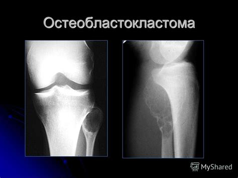 Презентация на тему: "Лучевая диагностика опухолей опорно ...