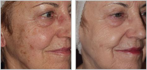 Forever Young BBL |Tyte Medispa Millbrook,NY