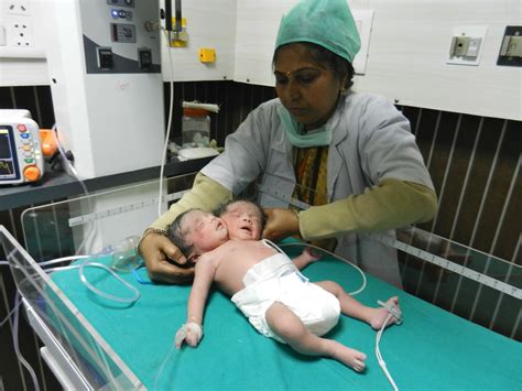 'Female Baby Having Two Heads' Born In India | HuffPost