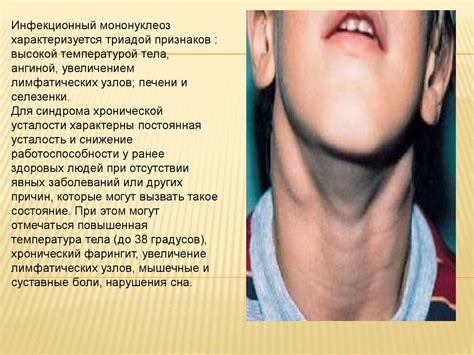 Инфекционный мононуклеоз - презентация онлайн
