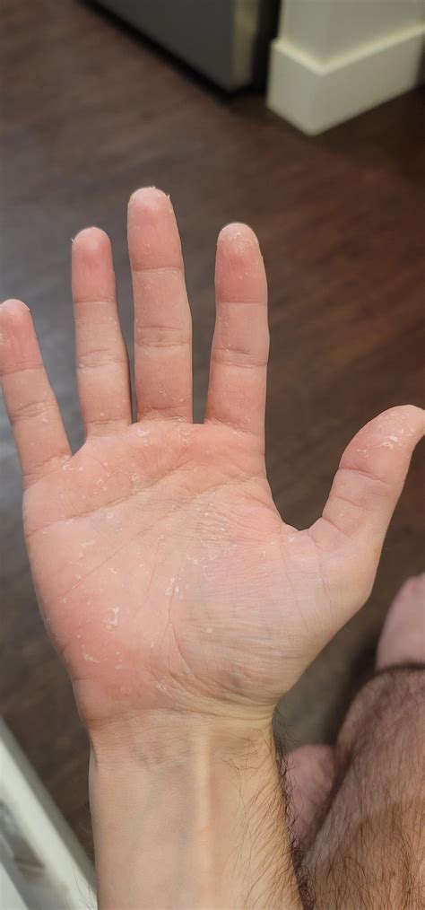 My hands have been peeling like this for a month straight now. Even