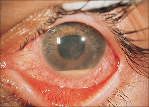 Hypopyon Uveitis | Ento Key