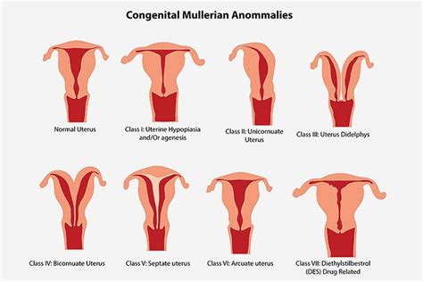 Congenital Uterine Anomalies | KJK Hospital & Fertility Research Centre ...