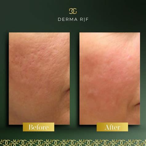 Derma Radio Frequency R|F | Derma Group Ltd