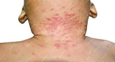 Bolinhas No Pescoço De Criança - Molusco contagioso no pescoço de criança asiática É uma condição comum ...