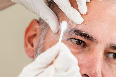 cryotherapy assure aesthetics cryotherapy st albans cryotherapy