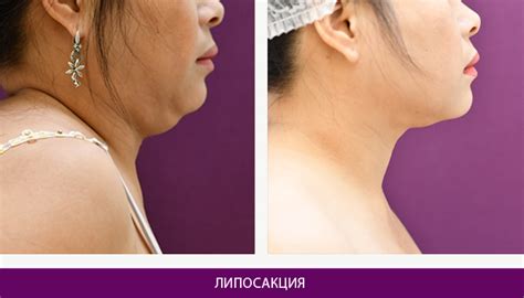 Липосакция в Киеве. Цена на липосакцию живота.
