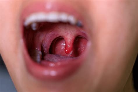 tonsillitis treatment symptoms  richardsons