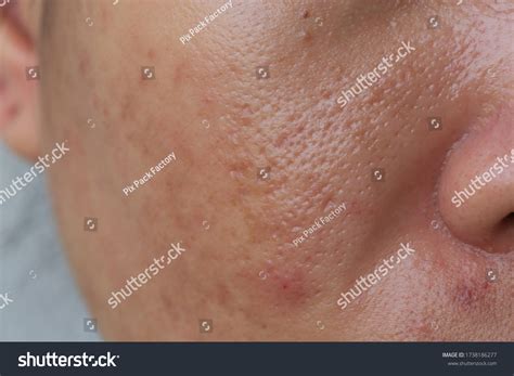 1,541 Large Pores Images, Stock Photos & Vectors | Shutterstock