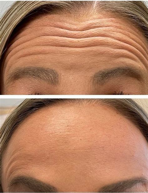 12 Benefits of Dysport and Botox - Hush LA Medspa