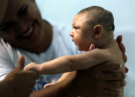 cdc confirms zika virus  microcephaly  birth defects