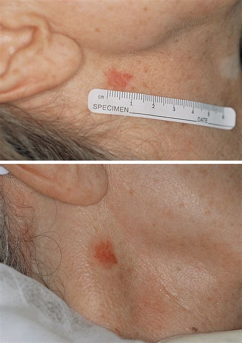 Basal Cell Carcinoma Stages Pictures at Gayla Wilson blog