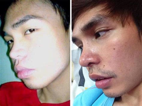3 Telltale Signs That Someone Has Had A Nose Job | Justinboey 