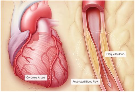 Top Cardiologists Offer Four Strategies for Preventing Coronary Artery