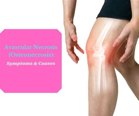 Avascular Necrosis (Osteonecrosis): Symptoms and Causes