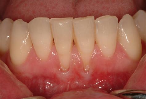 Types Of Gingival Recession at Lachlan Ricardo blog