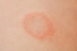What Does Ringworm Look Like?