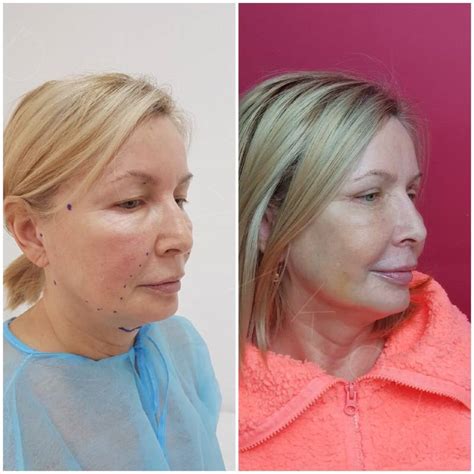 Нити для подтяжки лица после 50 лет: отзывы, фото до и после