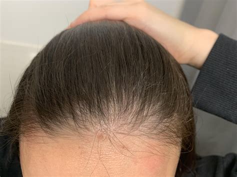 Why is hair loss so freaking cruel? Just a years worth of hair loss on