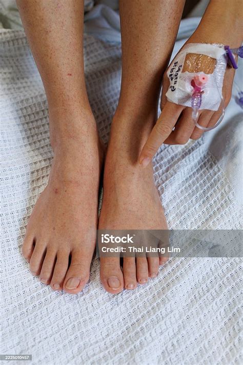 dengue fever rash  human leg stock photo  image