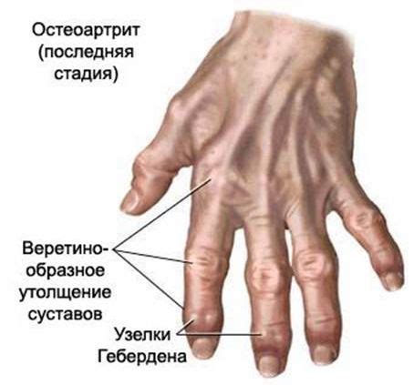 Артрит - лечение, симптомы, причины, диагностика | Центр Дикуля