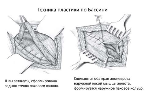 Паховые грыжи - презентация онлайн
