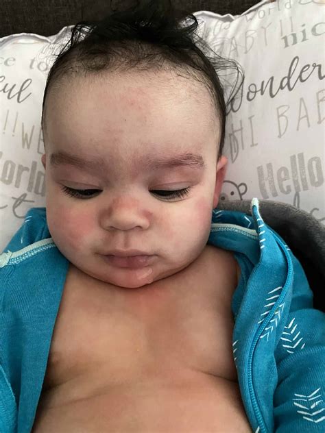 Symptoms of Allergic Reactions in Babies - Solid Starts