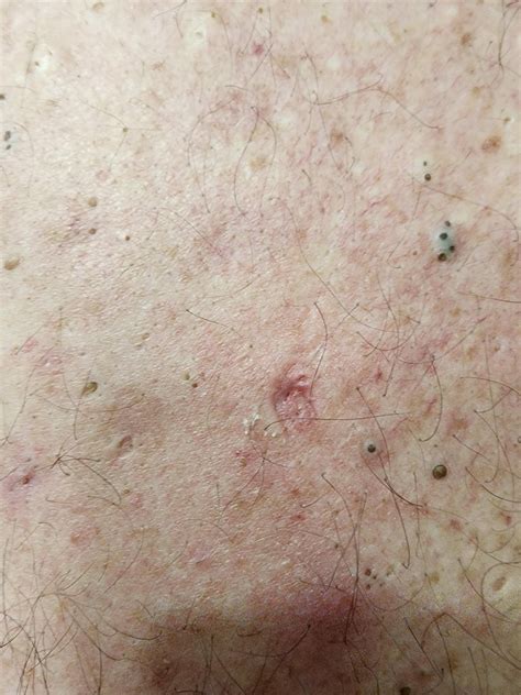Unbelievable Blackhead Removal 2024: Before And After Photos That Will Shock You! Image 12