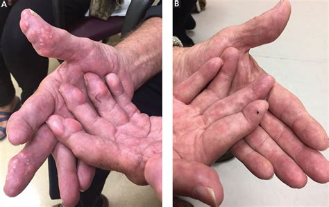 finger pads meaning  marsha morrissey blog