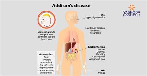 Adrenal Gland Disorders: Types, Causes, Symptoms, Diagnosis, Treatment and Complications