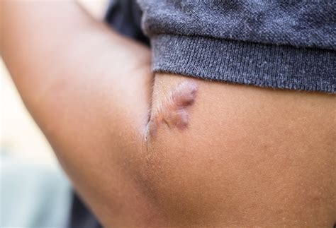 scar  easily heres      health