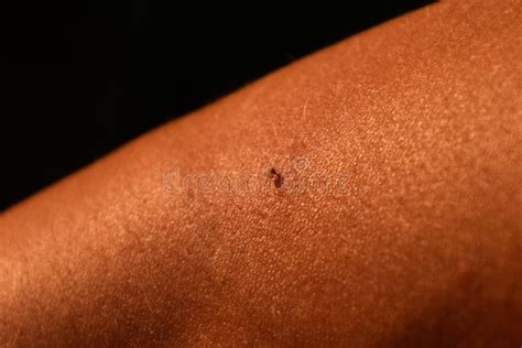 Bee Sting. Bee Sting in Human Skin. Consequences of Stinging with Bee Venom Stock Photo - Image ...