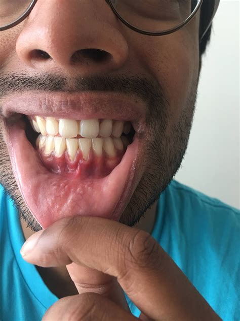 how to fix a receding gum line