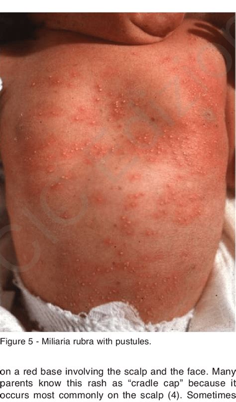Miliaria Rubra Face