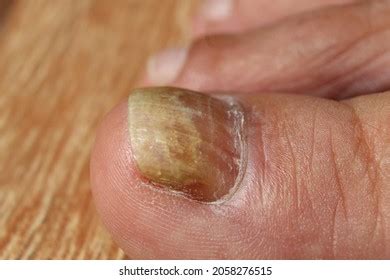 3+ Hundred Psoriatic Nails Royalty-Free Images, Stock Photos & Pictures ...