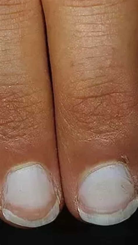 What Do Fingernails Look Like With Kidney Disease at Meagan Brown blog