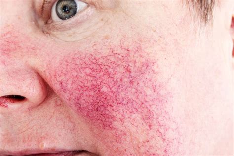redness   face  treatments