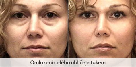 Omlazení obličeje vlastním tukem | Brandeis Clinic