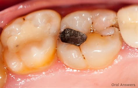 how much does a cavity filling cost with insurance 6