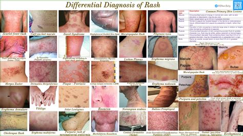 maculopapular rash maculopapular rash  appearance