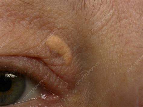 Cholesteatoma - Stock Image - C006/4008 - Science Photo Library