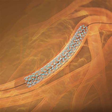 SYNERGY™ XD Everolimus-Eluting Platinum Chromium Coronary Stent System ...