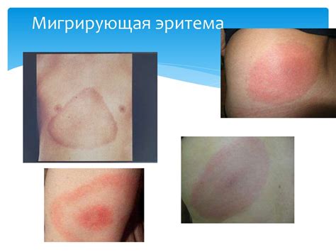Энцефалиты. Группа воспалительных заболеваний головного мозга человека ...