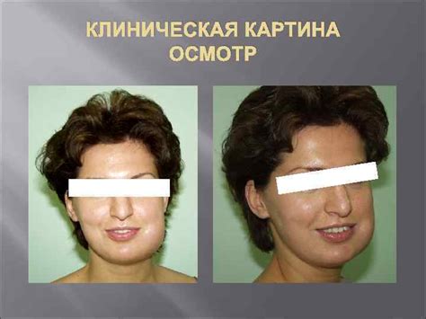 ОСТРЫЙ ГНОЙНЫЙ ПЕРИОСТИТ ЧЕЛЮСТЕЙ ОПРЕДЕЛЕНИЕ Периостит челюсти