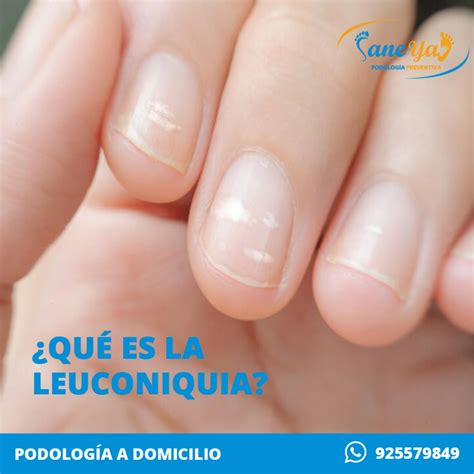 📌¿QUÉ ES LA LEUCONIQUIA? Es la... - Podología Sane Ya