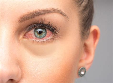 What is Ocular Rosacea? Symptoms, Causes & More