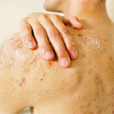 How OXY® Works – Oxy® Acne Care